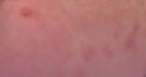 Imagem de capa do artigo: Acne Neonatal