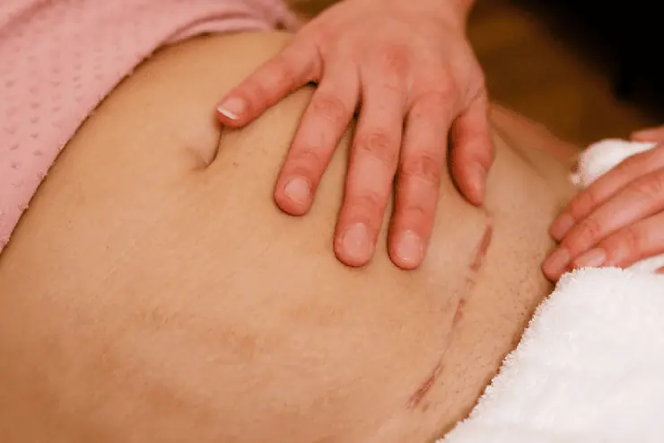 Tratamento cicatriz cesariana