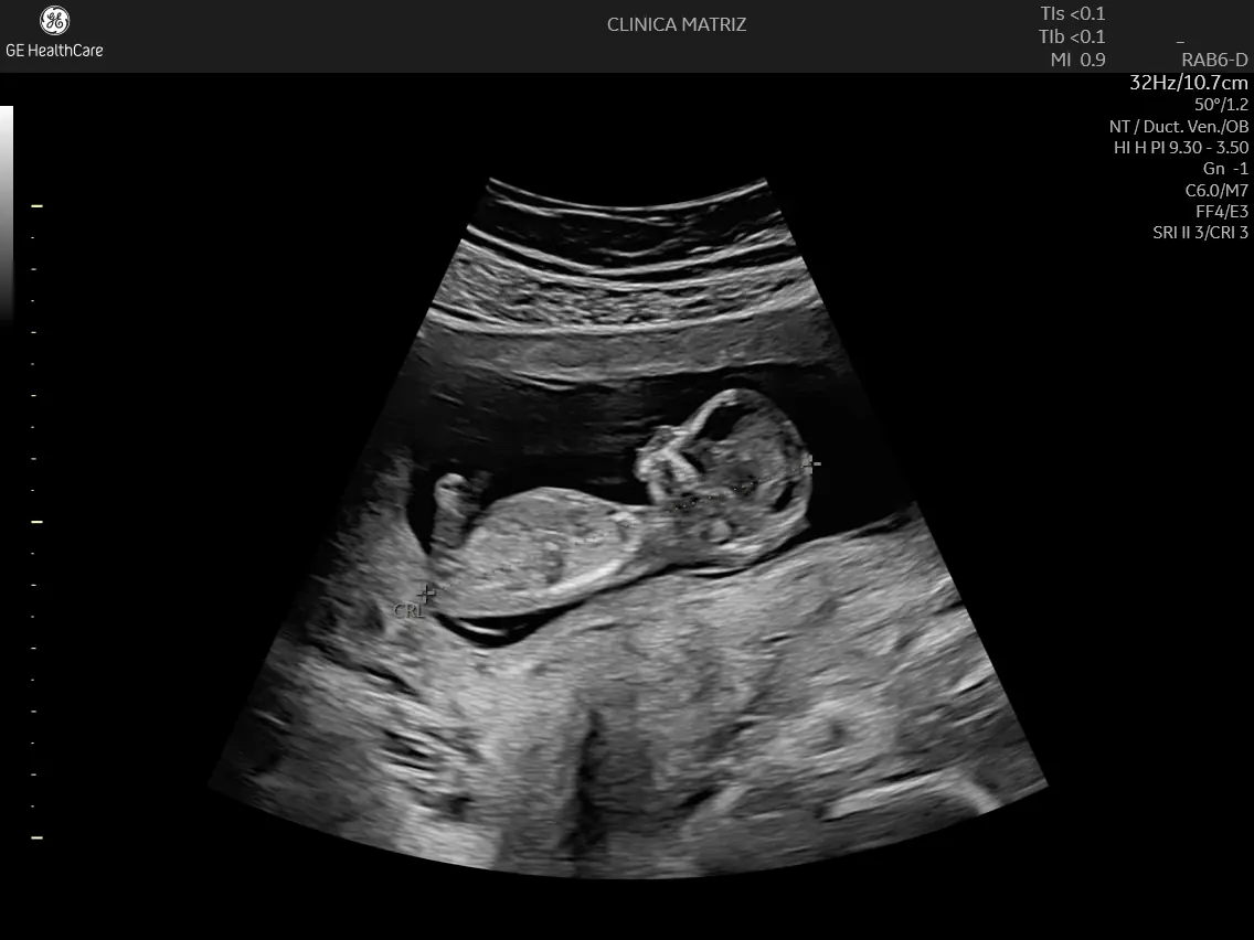 Ecografia obstétrica 2D com feto em perfil no 1º trimestre