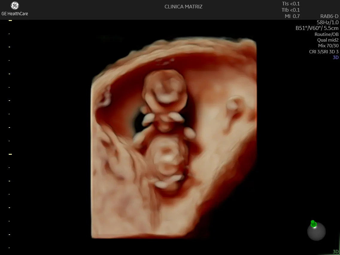 Ecografia obstétrica 3D do bebé no início da gravidez