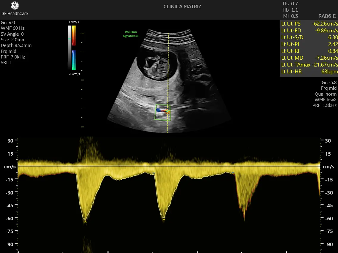 Ecografia obstétrica com Doppler para avaliação do fluxo sanguíneo