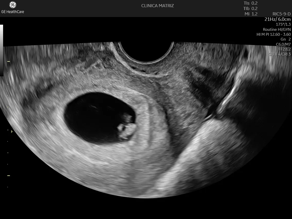 Ecografia obstétrica no início da gravidez com embrião visível