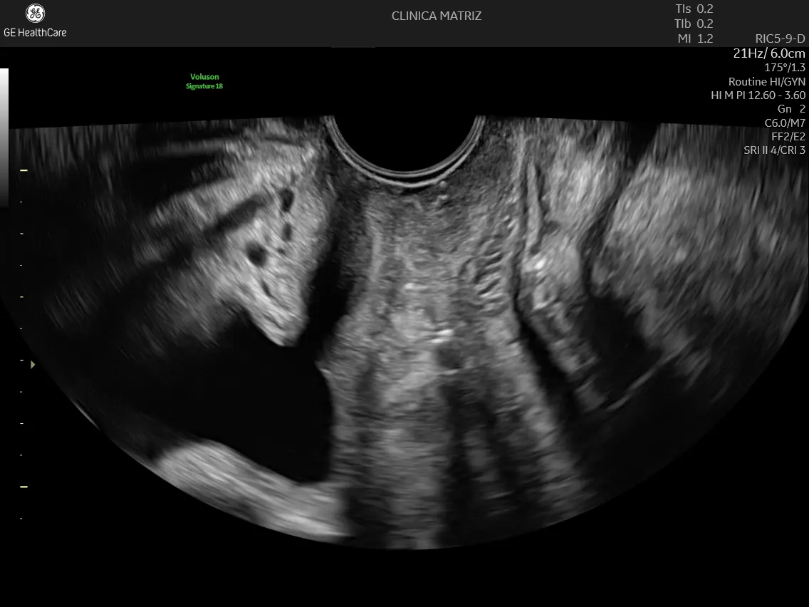 Imagem de histerossonossalpingografia visivel no ecógrafo