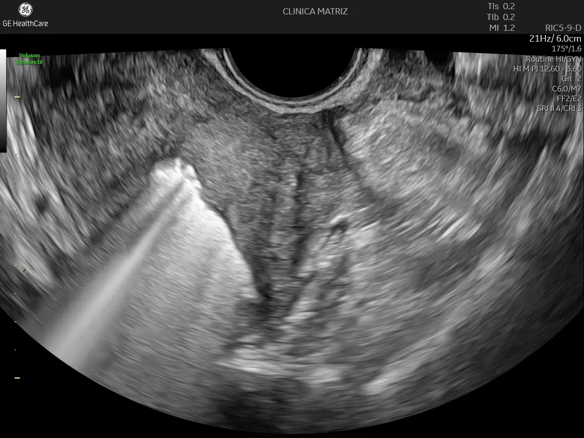 Imagem de histerossonossalpingografia visivel no ecógrafo